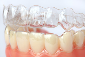 clear aligners katy tx