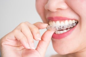 Clear Aligners & Invisalign