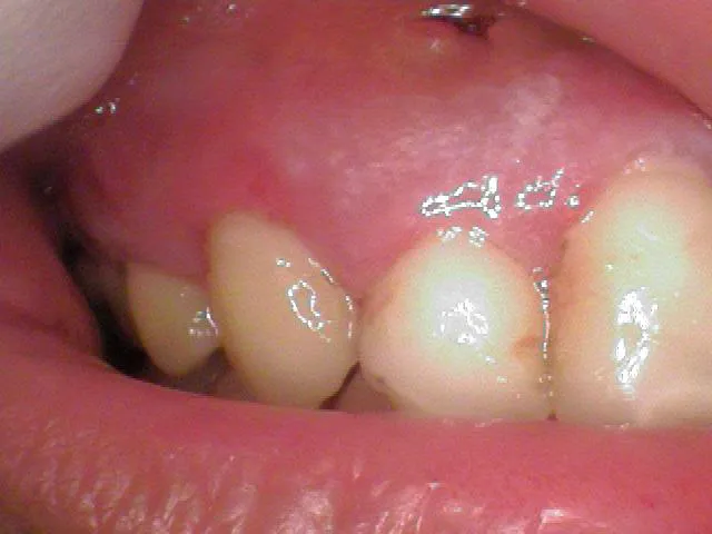 a tooth a day after a root canal procedure