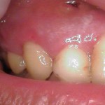 a tooth a day after a root canal procedure