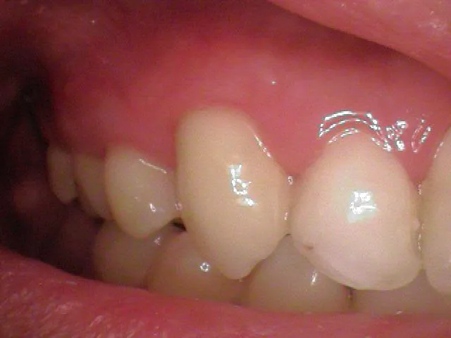 a tooth after receiving a root canal