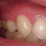 a tooth after receiving a root canal