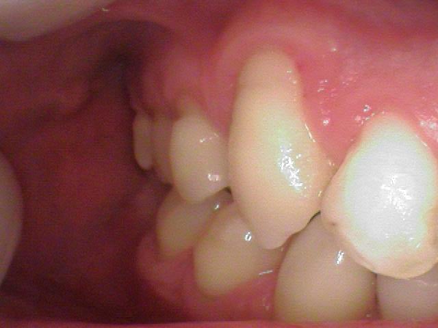a tooth in need of a root canal