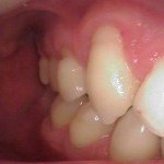 a tooth in need of a root canal