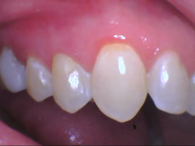 a healed tooth after a root canal procedure