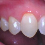 a healed tooth after a root canal procedure