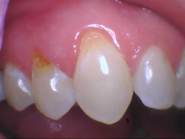 a closeup of teeth showing a lot of decay
