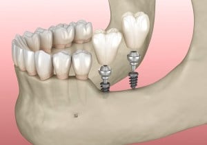 CGI dental implant and jaw
