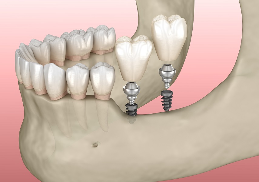 Tooth Click Ins Dental Implant FAQs | Replace Missing Teeth in Houston